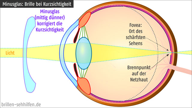 Minusglas (Streuungslinse) korrigiert die Kurzsichtigkeit (Myopie)