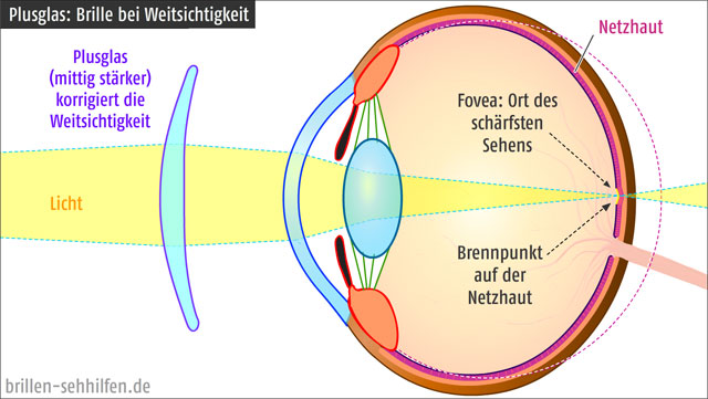 Plusglas (Sammellinse) korrigiert die Weitsichtigkeit (Hyperopie)