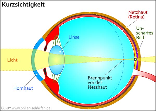 Weitsichtigkeit - Brennpunkt vor der Netzhaut